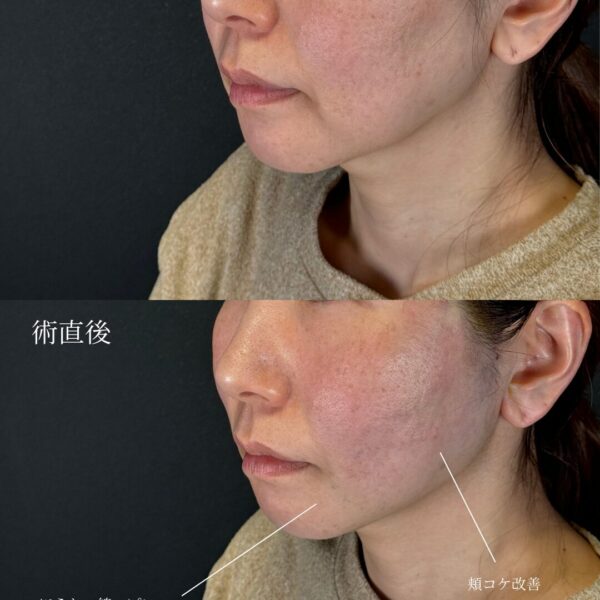 糸リフト（W式リフト）