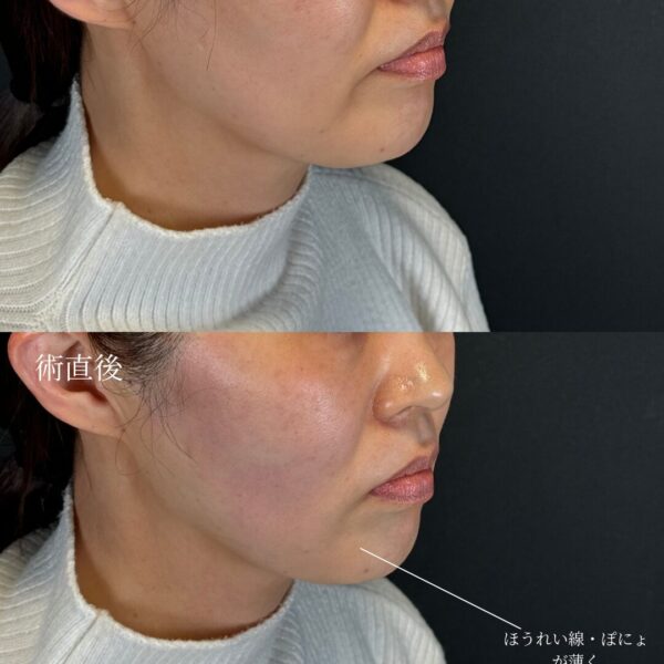 糸リフト（W式リフト）