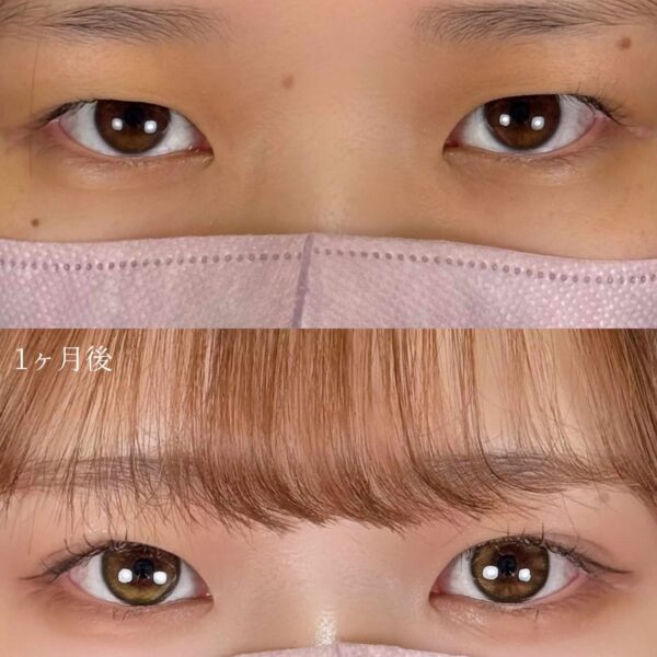 二重埋没法（自然癒着法）