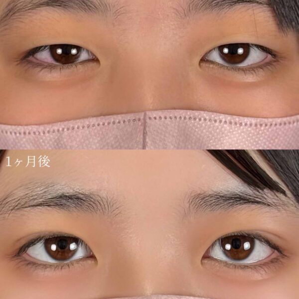 二重埋没法（自然癒着法）