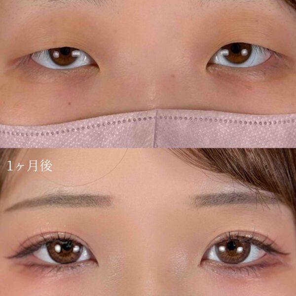 二重埋没法（自然癒着法）