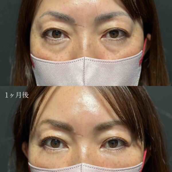 目の下のクマ治療