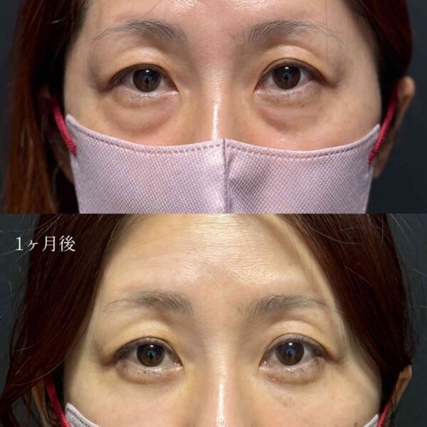 目の下のクマ治療