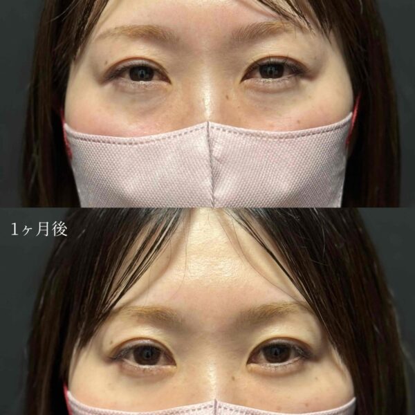 目の下のクマ治療