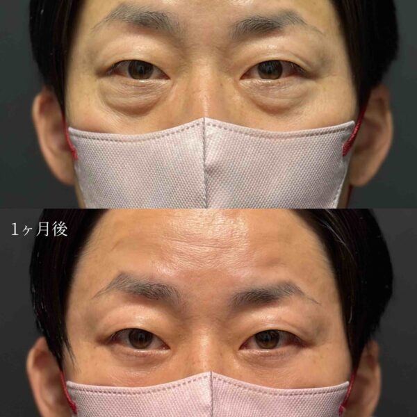 目の下のクマ治療