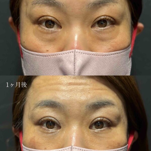 目の下のクマ治療