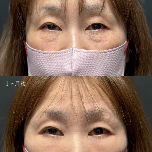 目の下のクマ治療