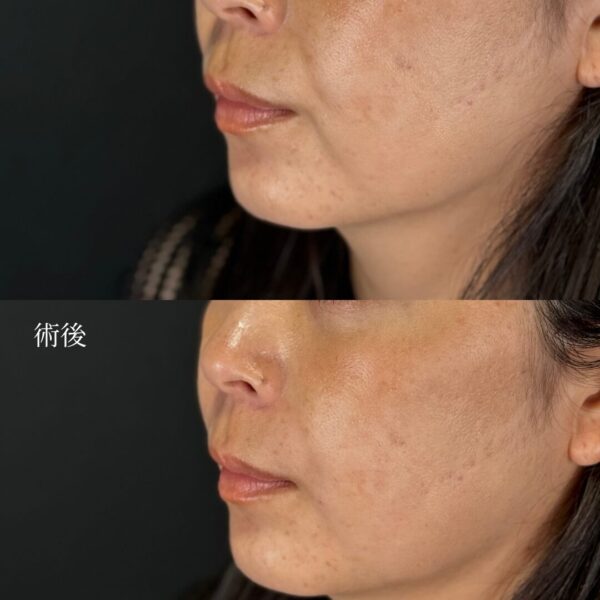 ほうれい線ヒアルロン酸