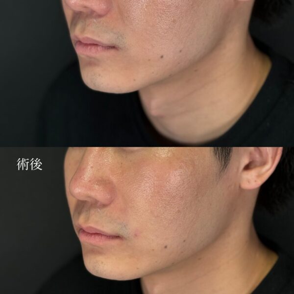 ほうれい線ヒアルロン酸