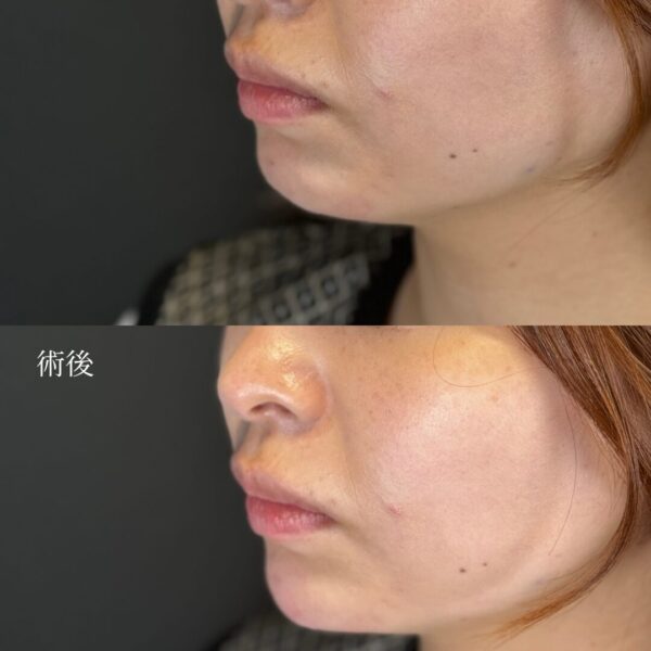 あごヒアルロン酸