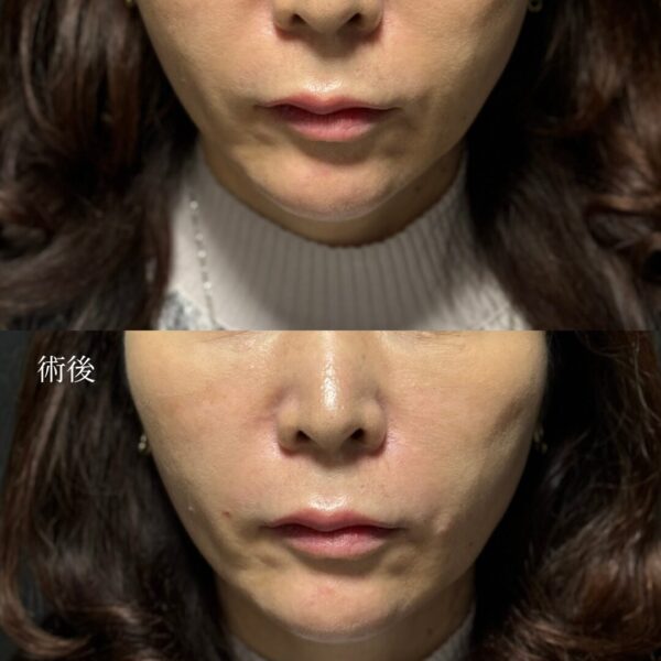 ほうれい線ヒアルロン酸