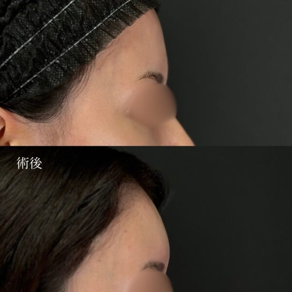 おでこヒアルロン酸