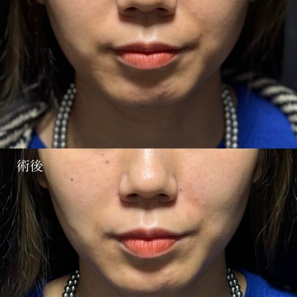 ほうれい線ヒアルロン酸