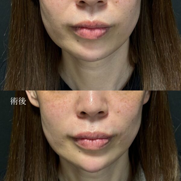 ほうれい線ヒアルロン酸