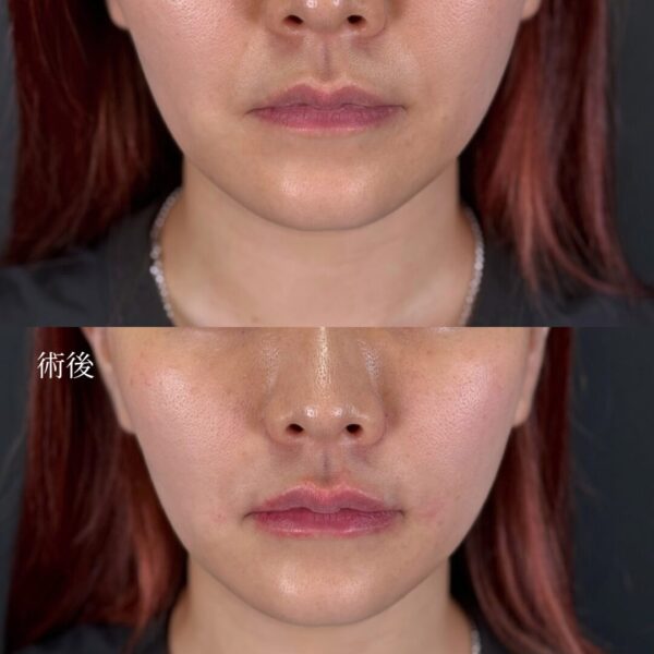 唇ヒアルロン酸