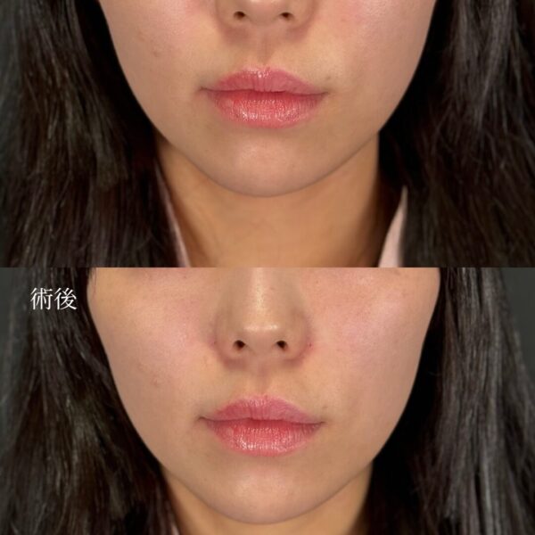 貴族ヒアルロン酸