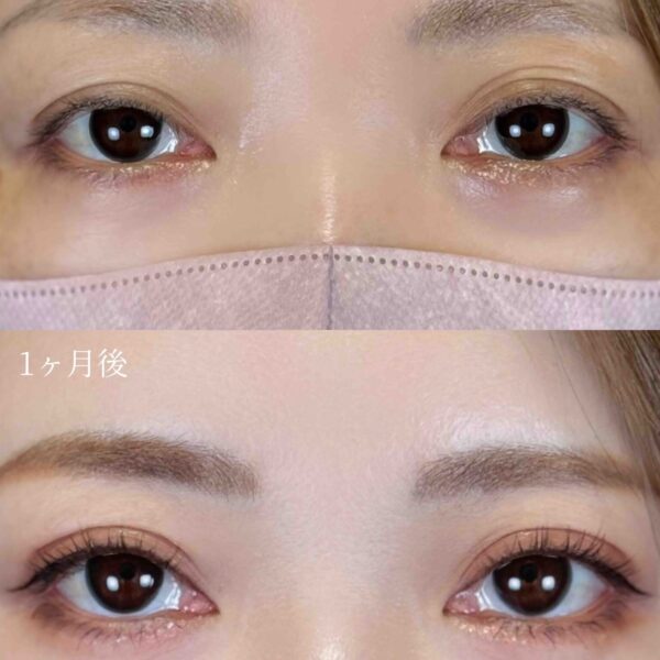 二重埋没法（自然癒着法）