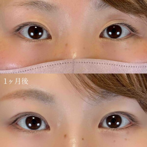 二重埋没法（自然癒着法）