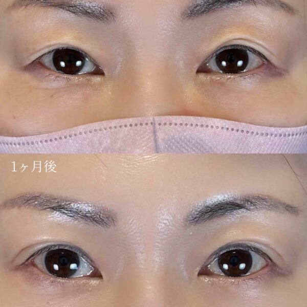 二重埋没法（自然癒着法）