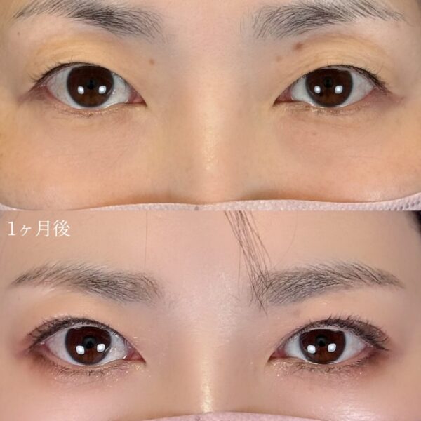 二重埋没法（自然癒着法）