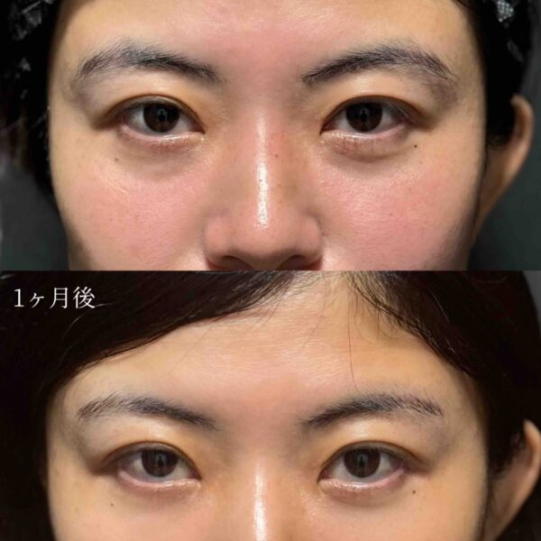 目の下のクマ治療