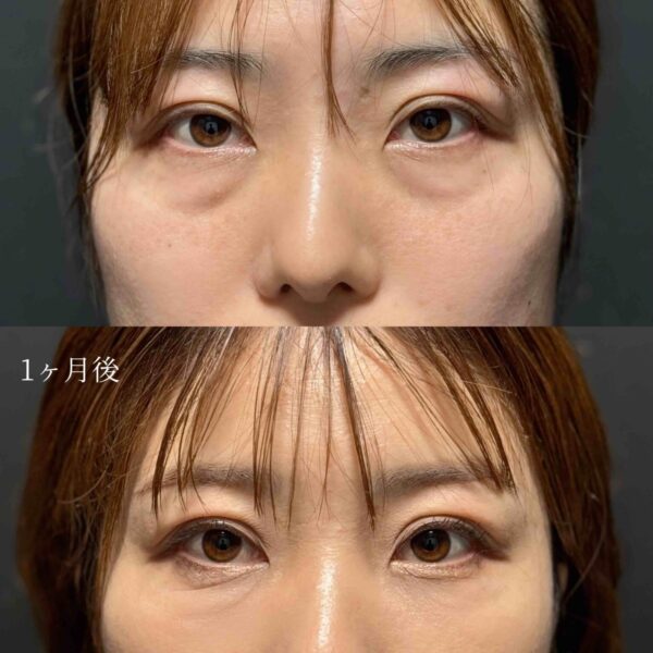 目の下のクマ治療