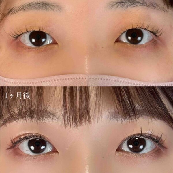 二重埋没法（自然癒着法）