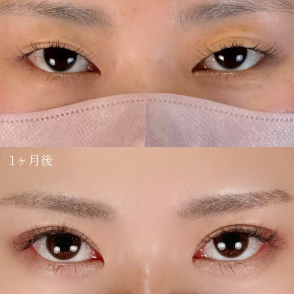 二重埋没法（自然癒着法）