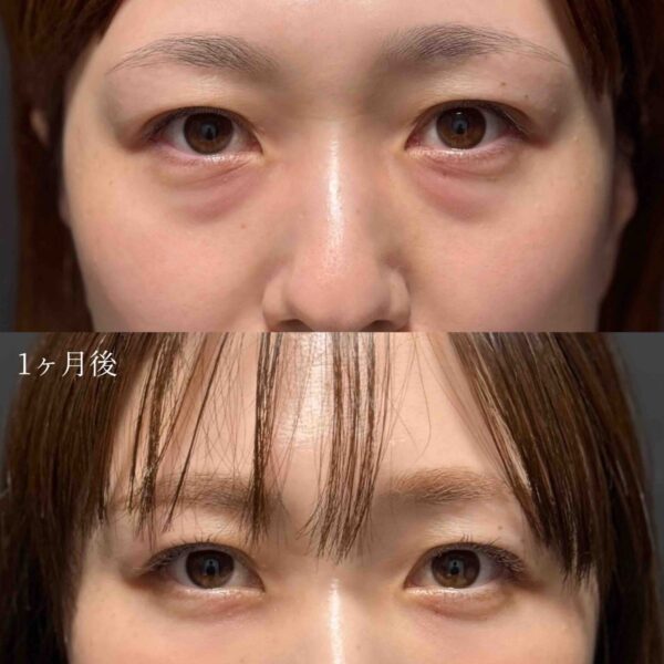 目の下のクマ治療