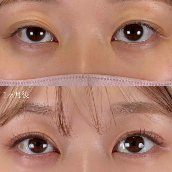 二重埋没法（自然癒着法）