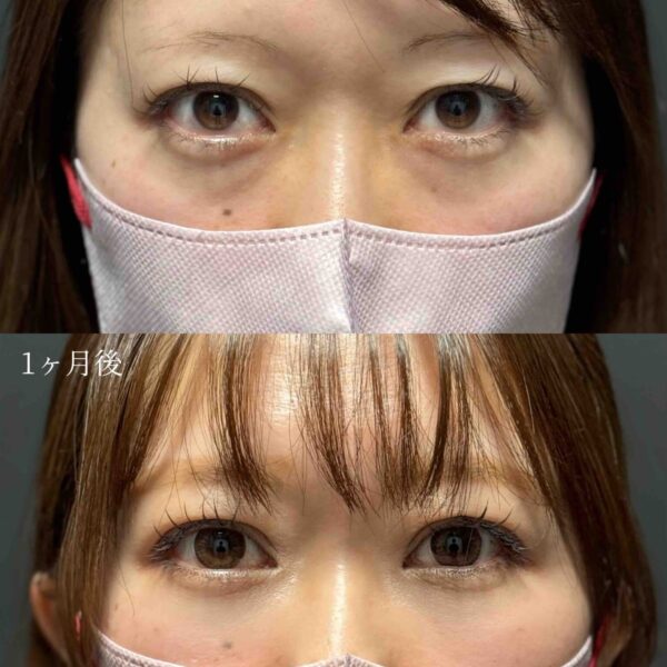 目の下のクマ治療