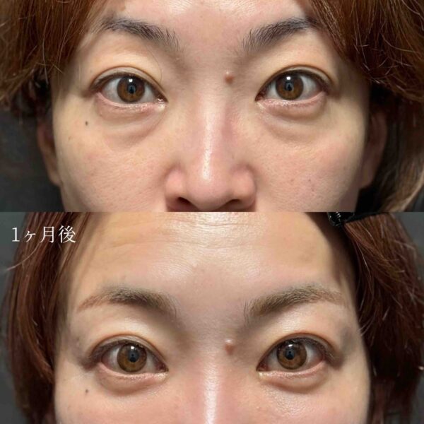 目の下のクマ治療