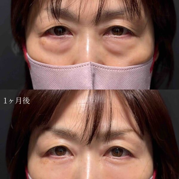 目の下のクマ治療