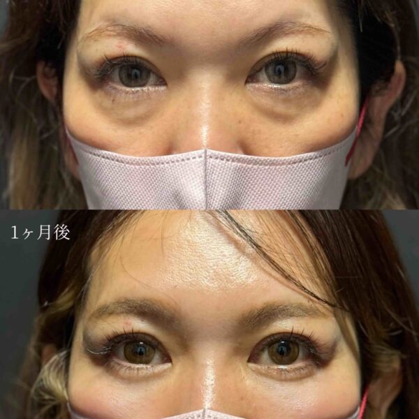 目の下のクマ治療