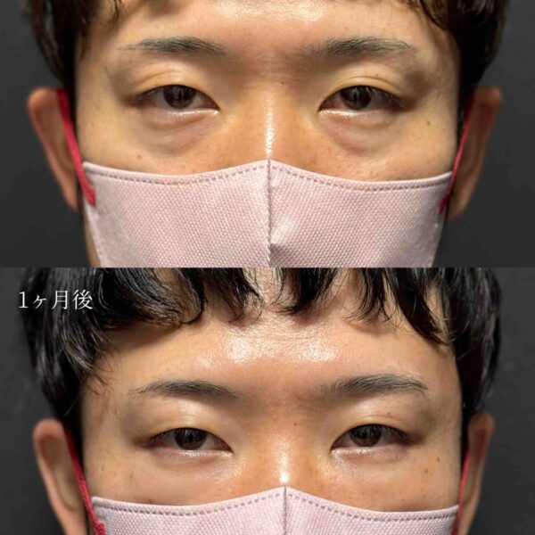 目の下のクマ治療