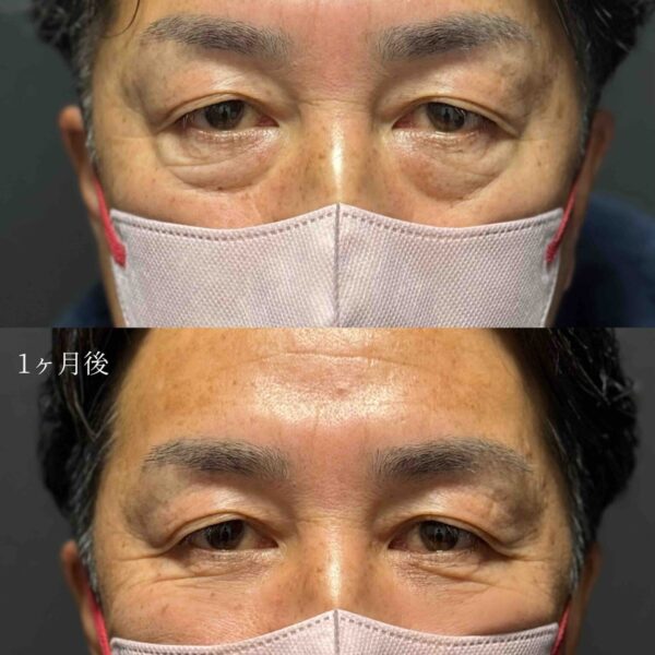 目の下のクマ治療