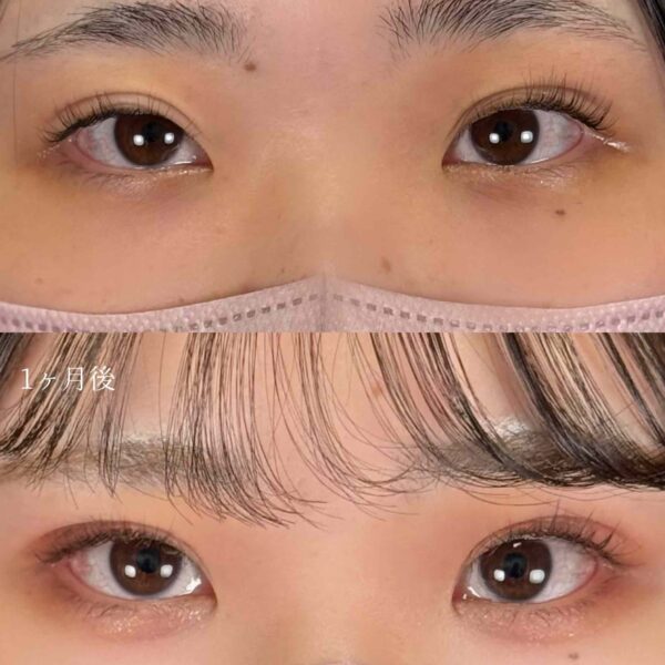 二重埋没法（自然癒着法）