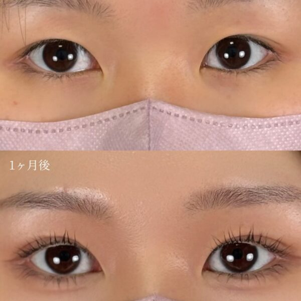 二重埋没法（自然癒着法）