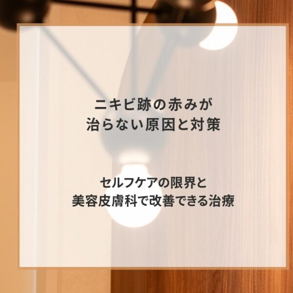 ニキビ跡の赤みが治らない原因と対策｜セルフケアの限界と美容皮膚科で改善できる治療