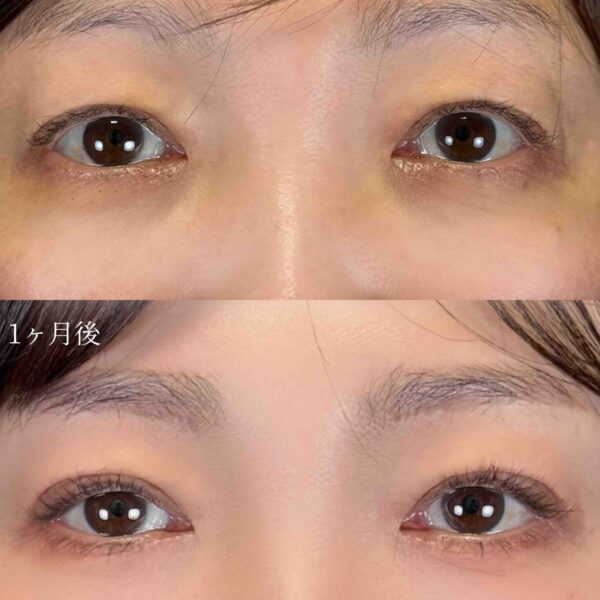 二重埋没法（自然癒着法）